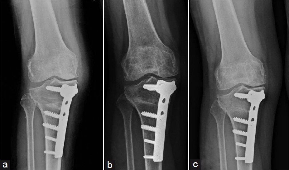 high tibial osteotomy (hto) or knee surgery in chembur mumbai